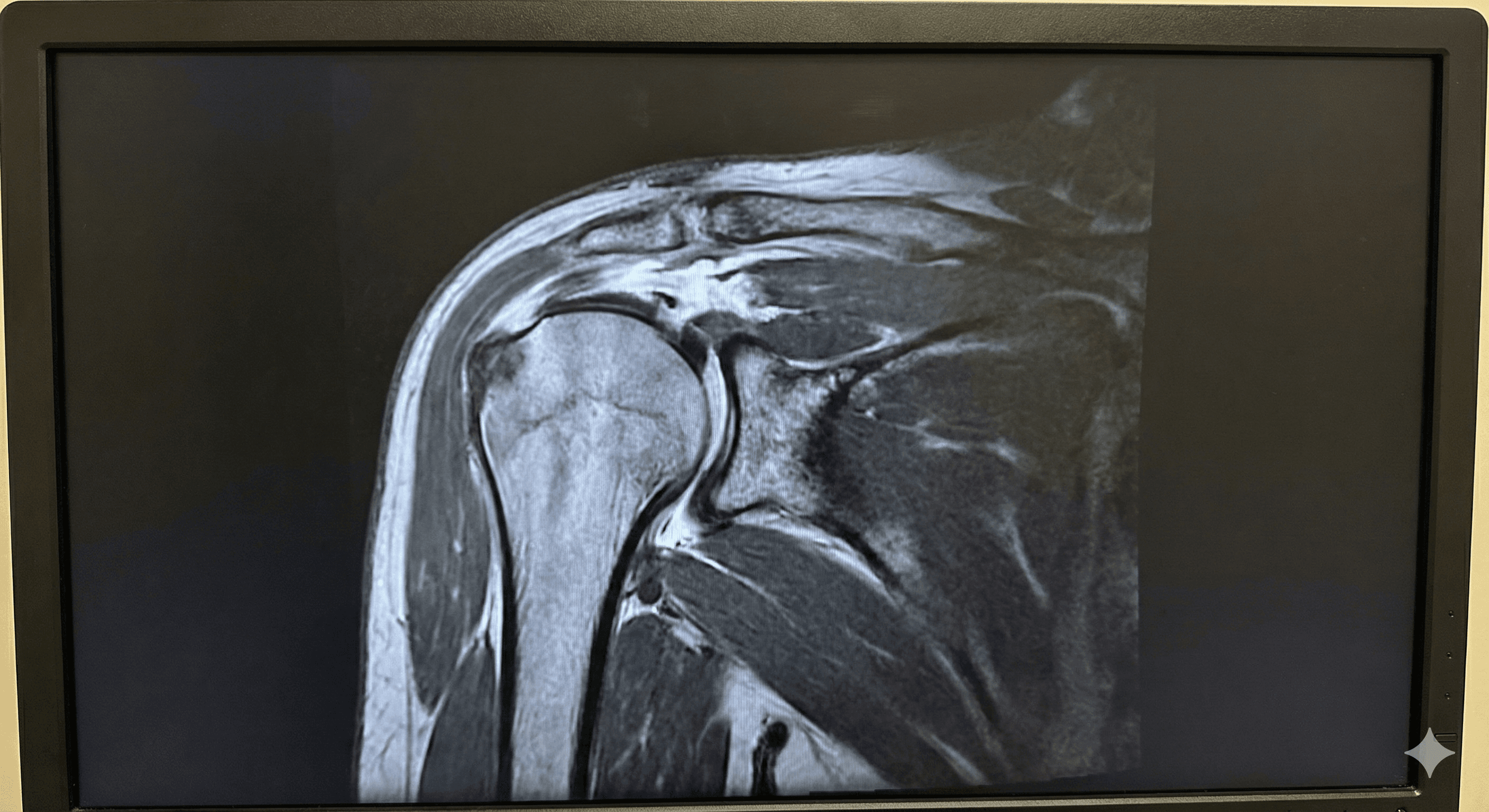 Lesión de manguito rotador